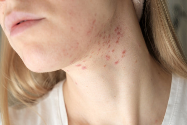 acne-prone-skin-tips