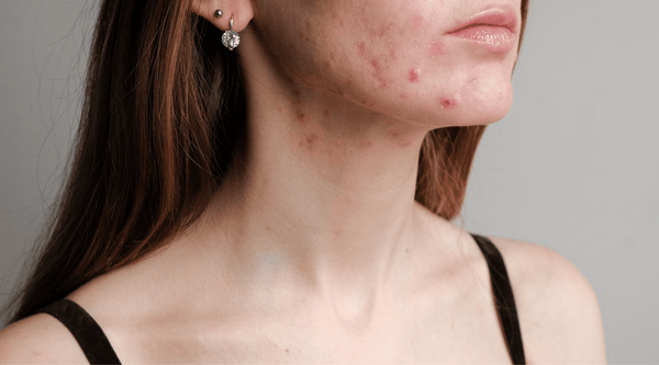 Fungal Acne vs Closed Comedones