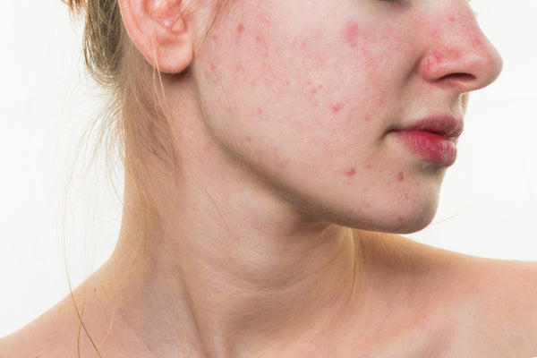 visible acne redness