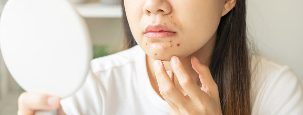 pimples around the mouth