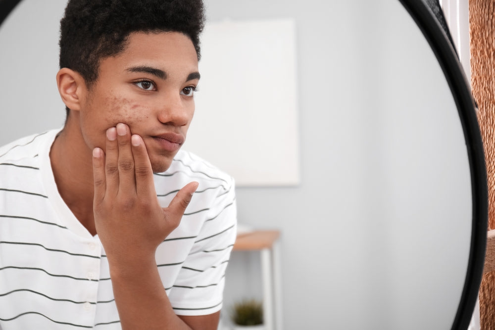 does-acne-go-away-with-age