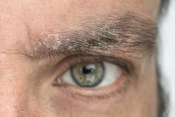 eyebrow dandruff