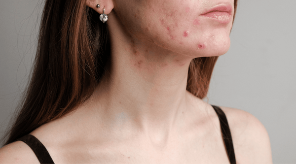 fungal-acne-skincare-treatment