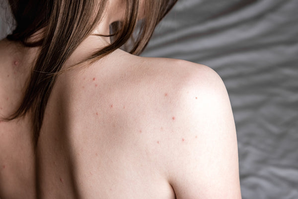 How To Get Rid Of Shoulder Acne Once And For All